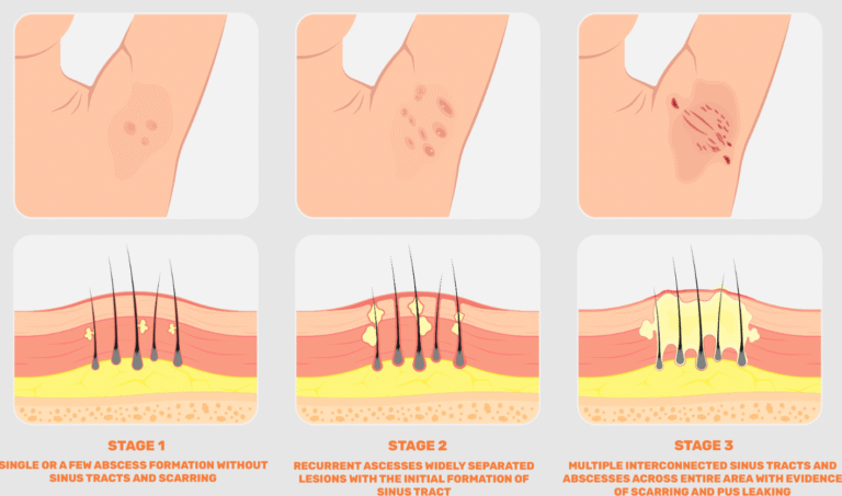 Stages of Hidradenitis Suppurativa (HS)